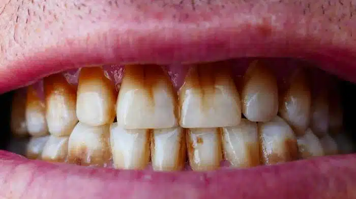 Tobacco Stains on Teeth