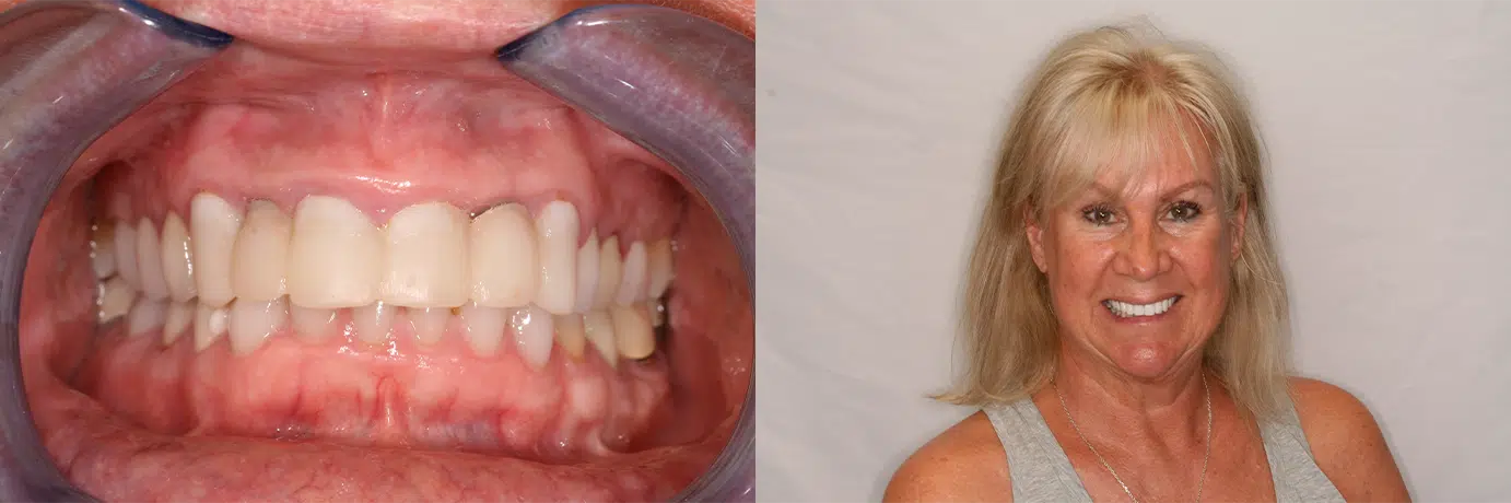 Tooth-Colored Porcelain Crowns