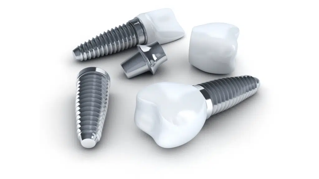 How To Know If You Are A Viable Candidate For Dental Implants