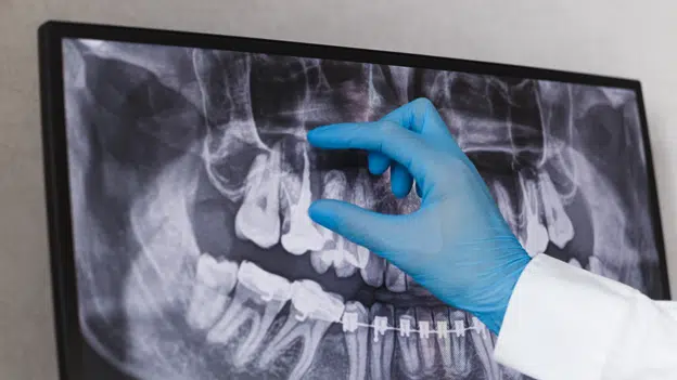 How to Spot Signs of a Root Canal Infection